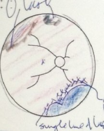 My latest retina sketch. After each visit the doctor sits down and does a sketch. The thickly colored sections are where repairs have been done during each vitrectomy.  The bottom is the most recent repair.